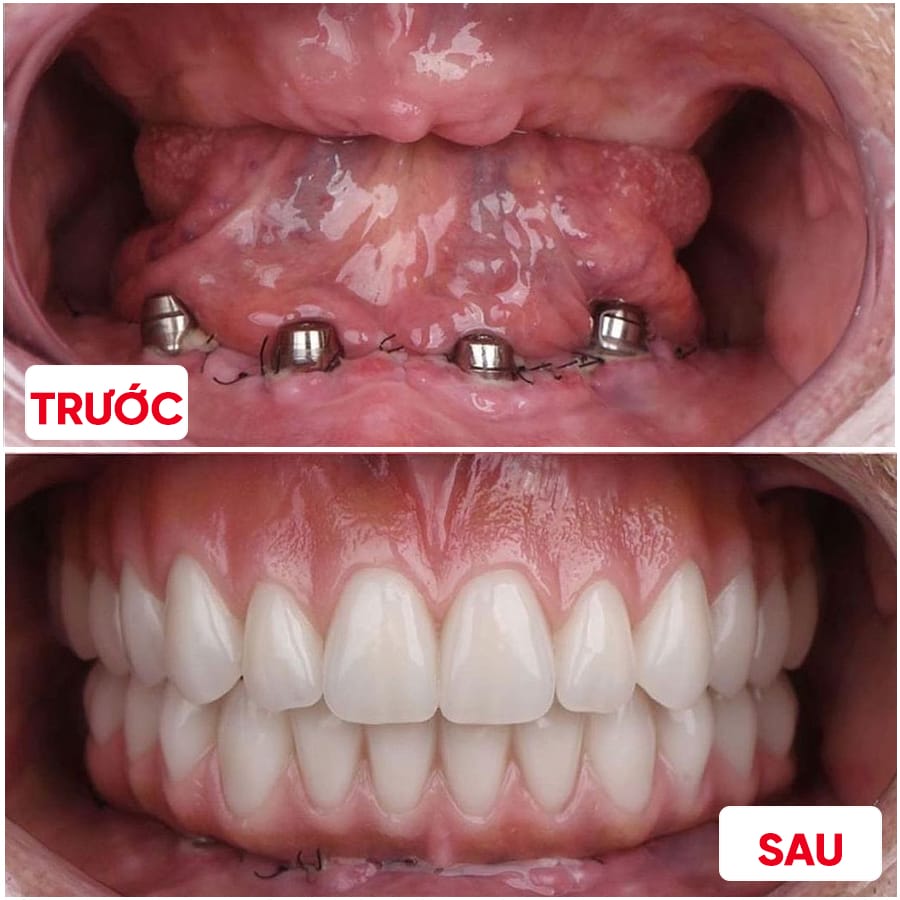 trồng implant toàn hàm