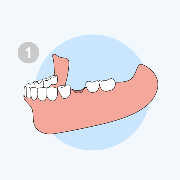 bước 1 trồng răng implant