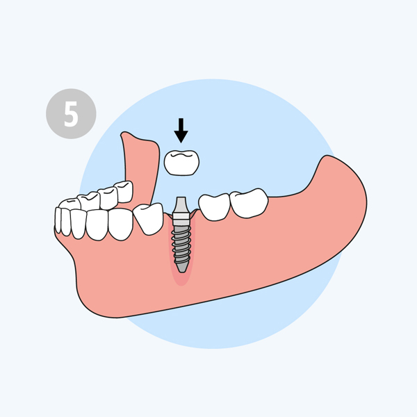 phục hình răng sứ trên implant