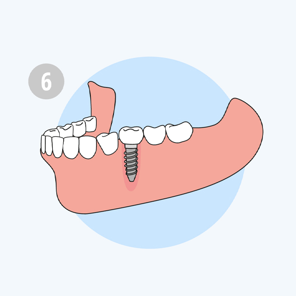 phục hình răng implant