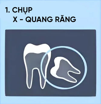 chụp x quang răng