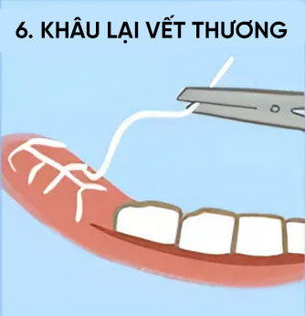 khâu vết thương