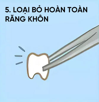 tiểu phẫu răng khôn