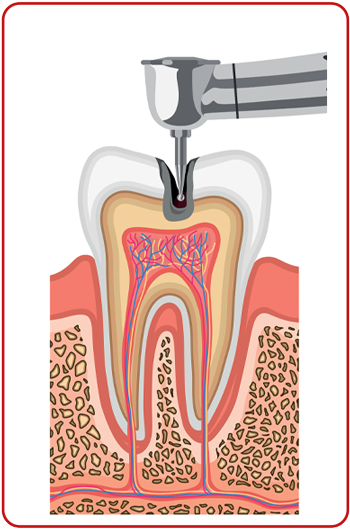 các bước chữa tủy răng