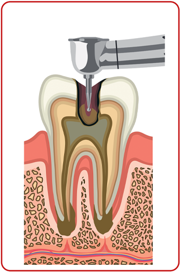 các bước chữa tủy răng