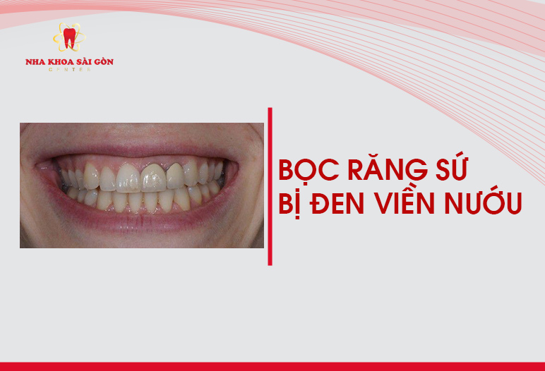 bọc răng sứ bị đen đường viền nướu