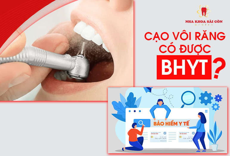 cạo vôi răng có được bảo hiểm y tế