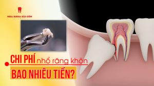 nhổ răng số 8 bao nhiêu tiền
