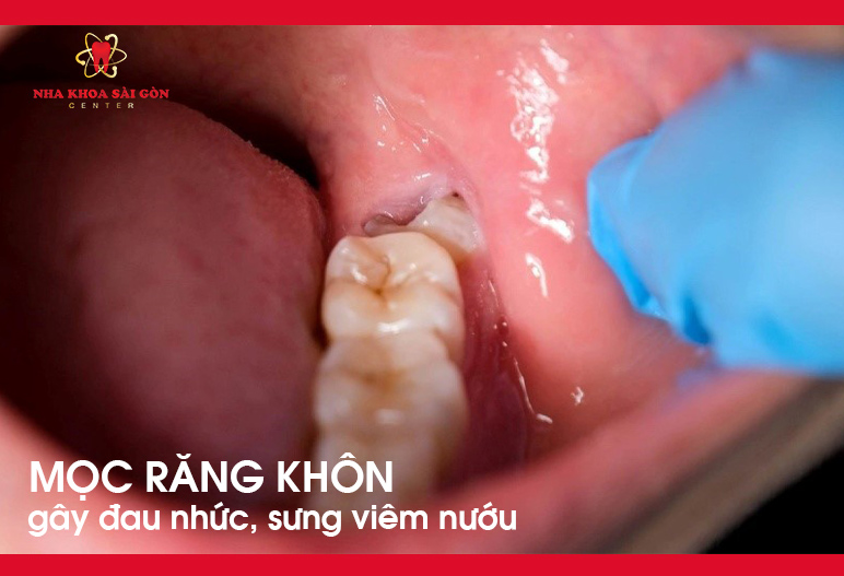 mọc răng khôn gây đau nhức răng