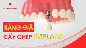 giá cấy ghép implant
