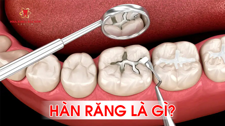 hàn răng là gì