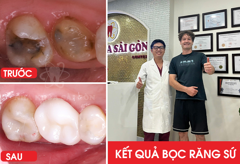 Kết quả bọc răng sứ