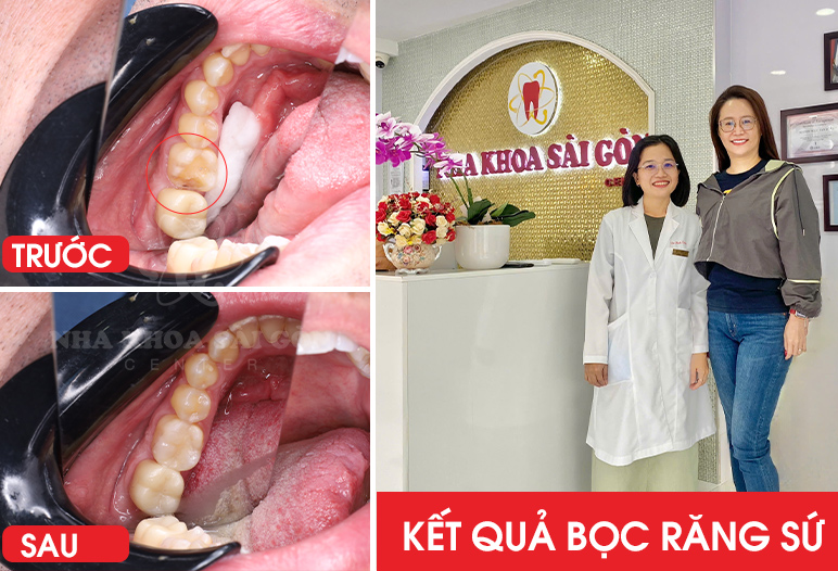 Kết quả bọc răng sứ