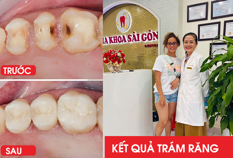 kết quả trám răng 