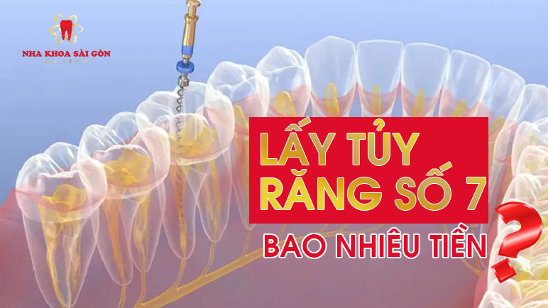 lấy tủy răng bao nhiêu tiền