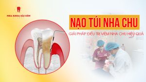 nạo túi nha chu