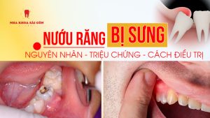 nướu răng bị sưng