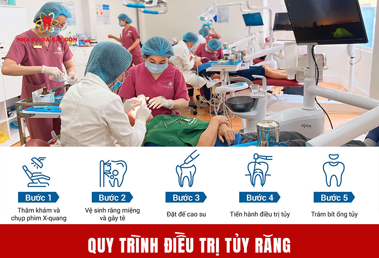 quy trình điều trị tủy răng