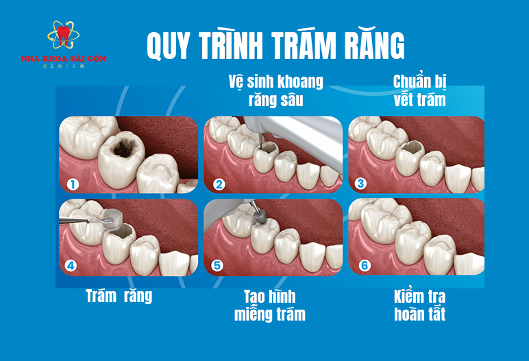 Các bước trám răng sâu