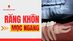 răng khôn mọc ngang