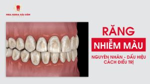 răng nhiễm màu