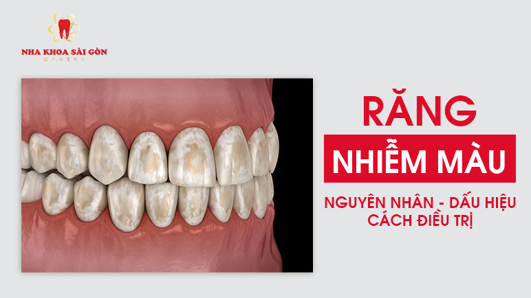 răng nhiễm màu