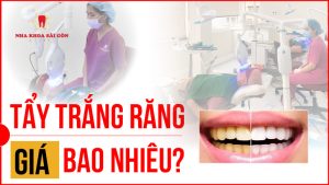 giá tẩy trắng răng