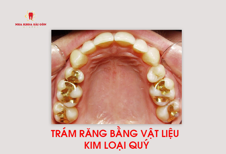 trám răng bằng vật liệu kim loại quý