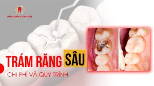 hàn trám răng sâu