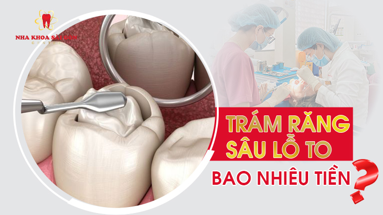 trám răng sâu lỗ to bao nhiêu tiền