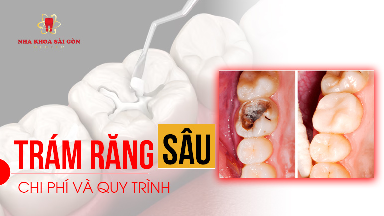 hàn trám răng sâu