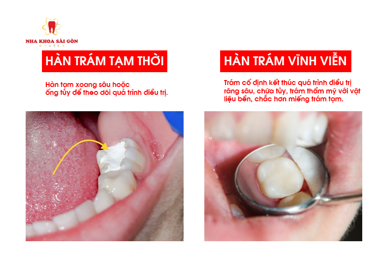 Trám răng tạm và trám răng cố định