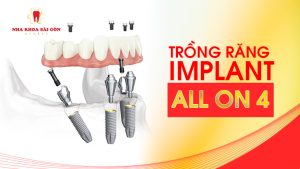 trồng răng implant all on 4