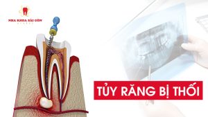 tủy răng bị thối