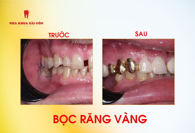 bọc răng vàng