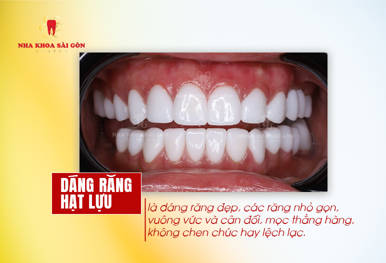 dáng răng hạt lựu là gì