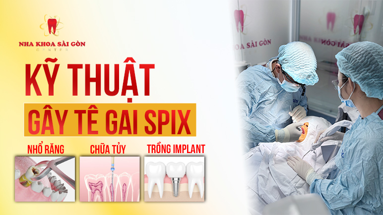 gây tê gai spix là gì