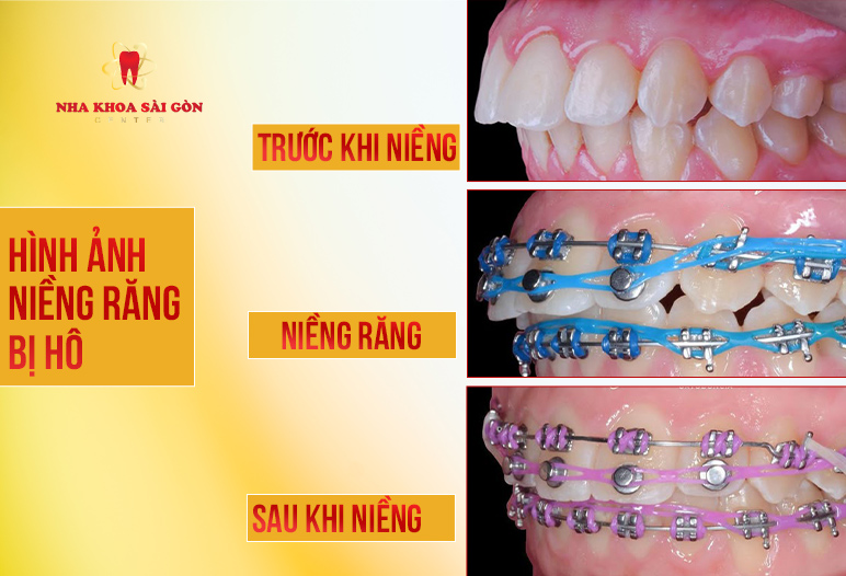 Hình ảnh trước và sau khi niềng răng 