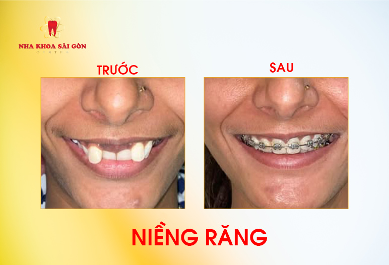 kết quả niềng răng