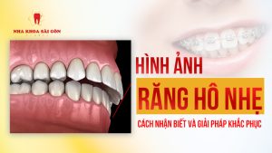 hình ảnh răng hô nhẹ