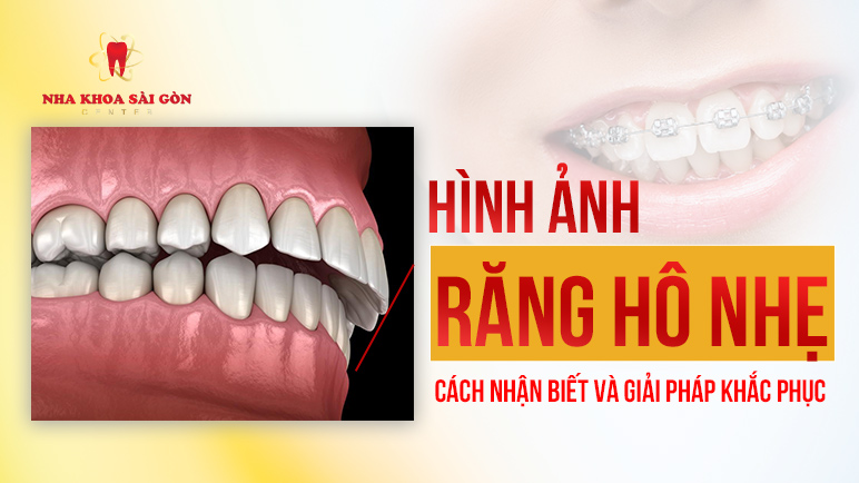 hình ảnh răng hô nhẹ 