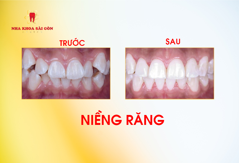 hình ảnh niềng răng trước sau