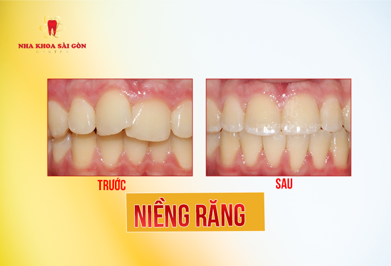 niềng răng khấp khểnh