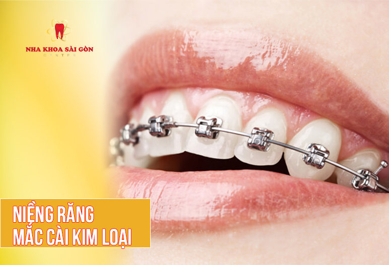 niềng răng mắc cài kim loại