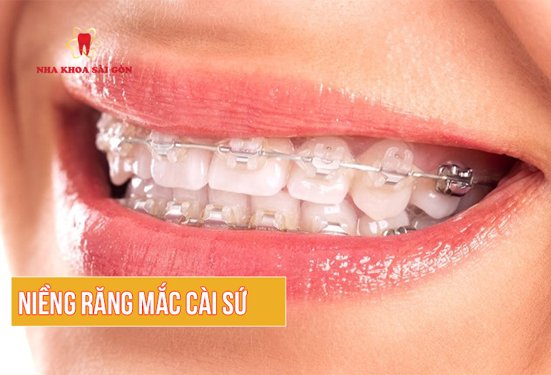 niềng răng mắc cài sứ