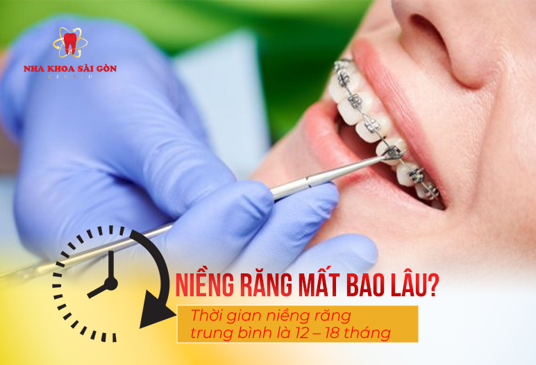 niềng răng bao lâu