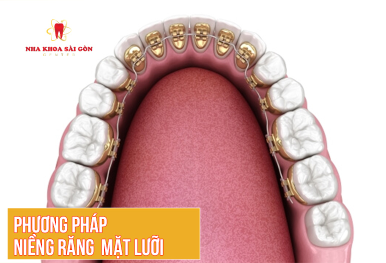 phương pháp niềng răng mặt lưỡi