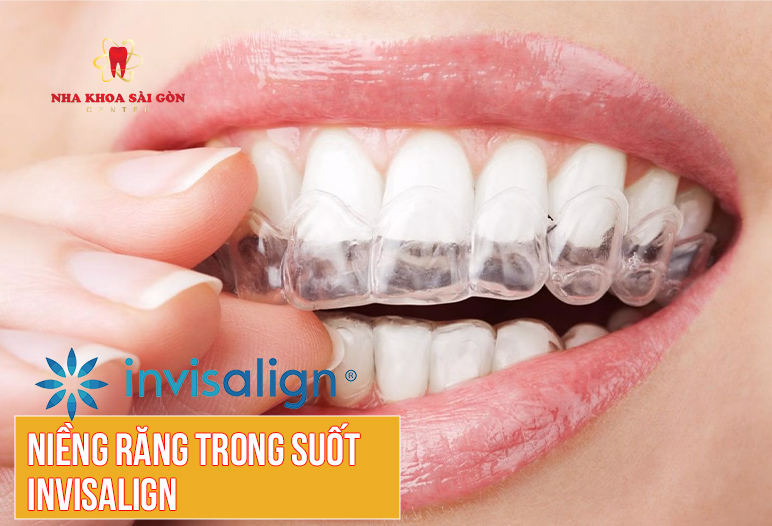 phương pháp niềng răng trong suốt