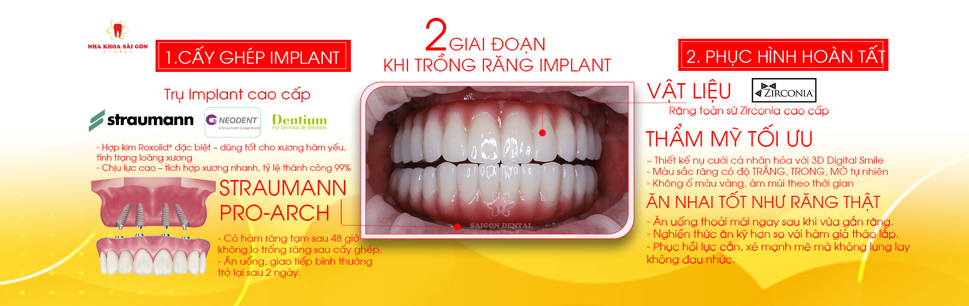 trồng răng implant mất bao lâu